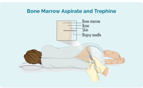 bone marrow biopsy to diagnose or stage lymphoma