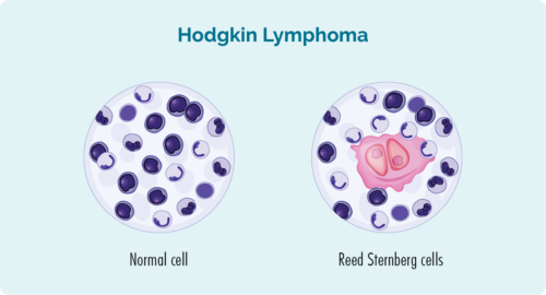 Reed-Sternberg cells are the hallmark on hodgkin lymphoma