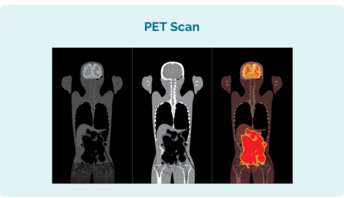 During a PET scan, any lymphoma cells absorb the radioactive dye and light up on the PET