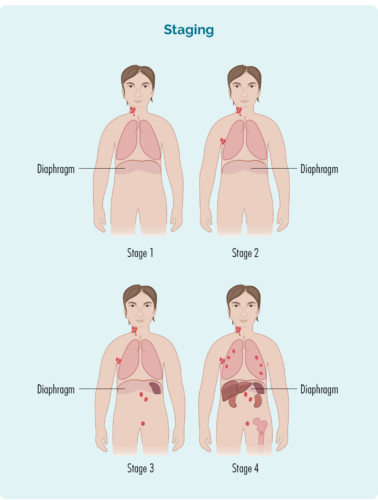 Staging of lymphoma