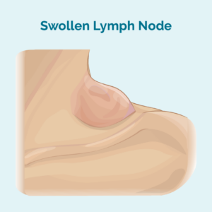 Swollen lymph node (gland)