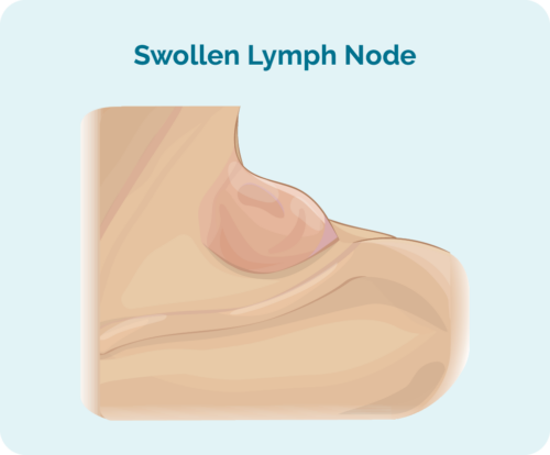 Swollen lymph node (gland)