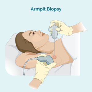 lymph node biopsy