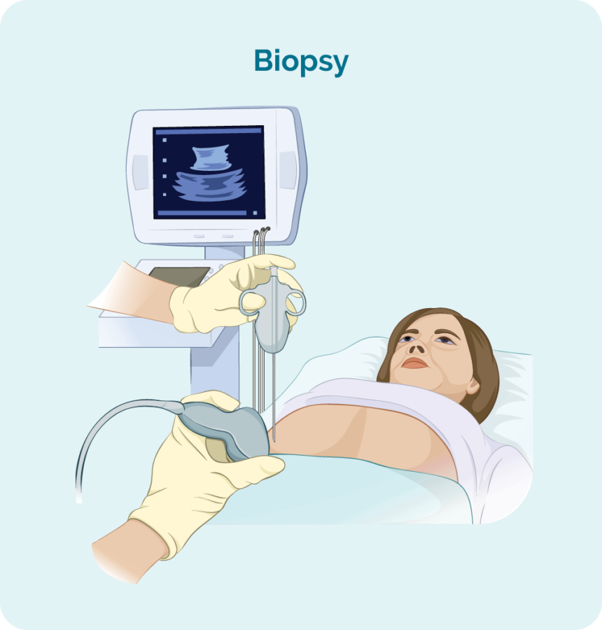 Ultrasound guided biopsy of swollen lymph node